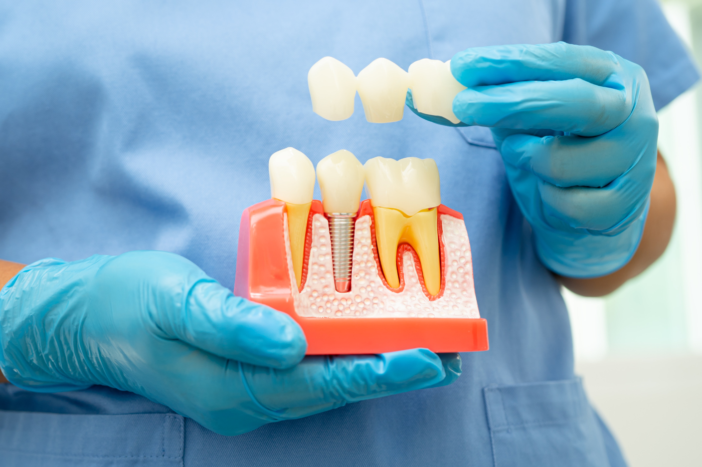 Achieve a Perfect Smile with Gum Contouring