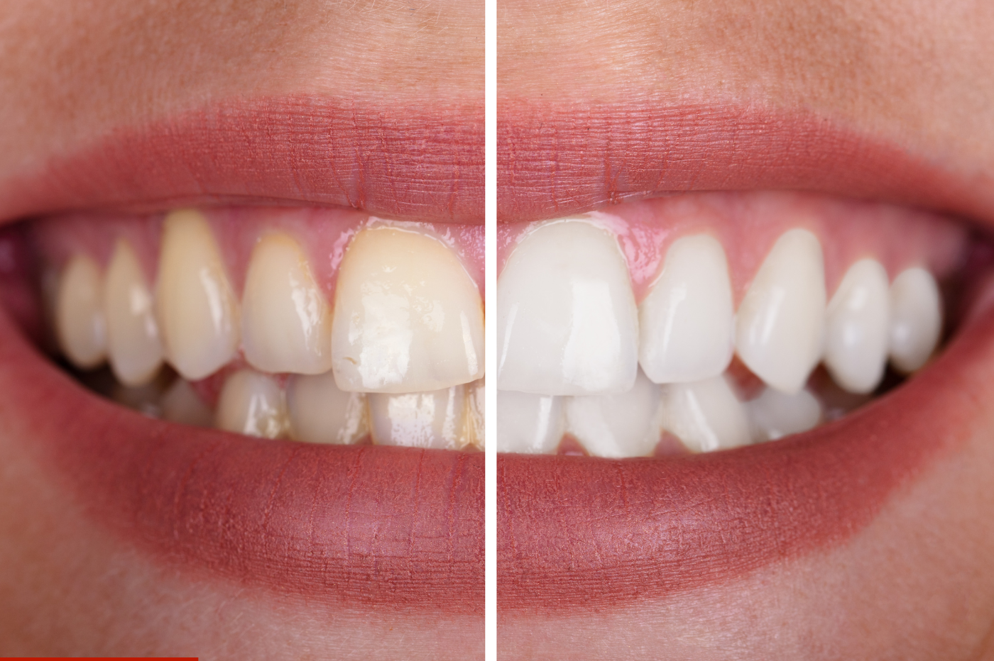 Dental Veeners