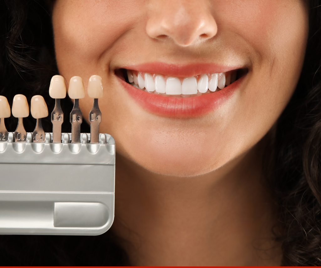Teeth Whitening