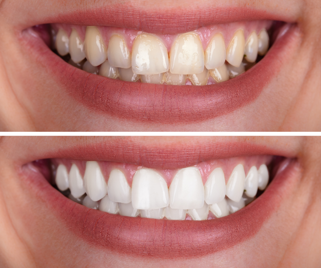 Zoom Teeth Whitening for a Radiant Smile