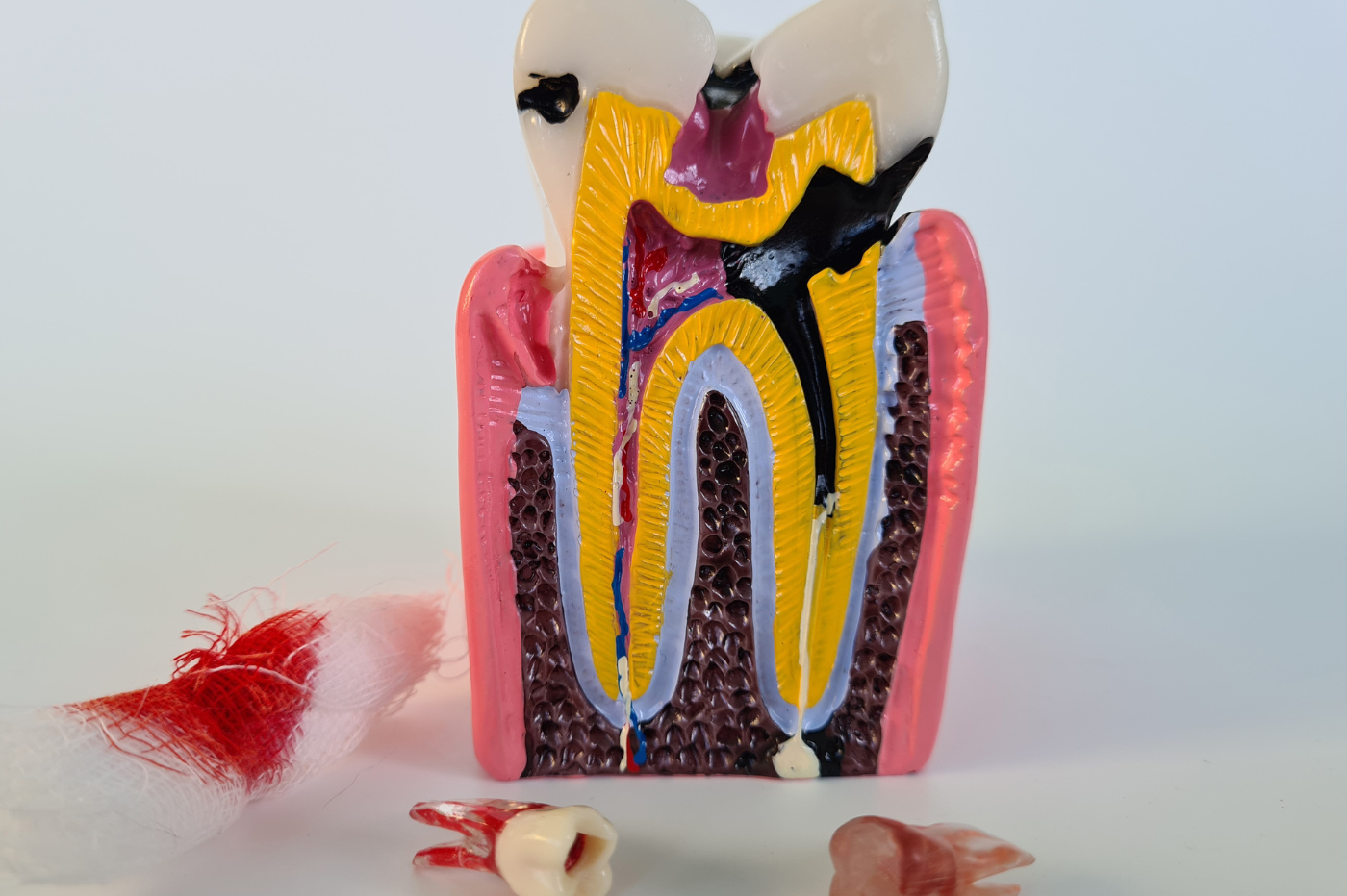 ROOT CANAL TREATMENT FOR DECIDUOUS TEETH