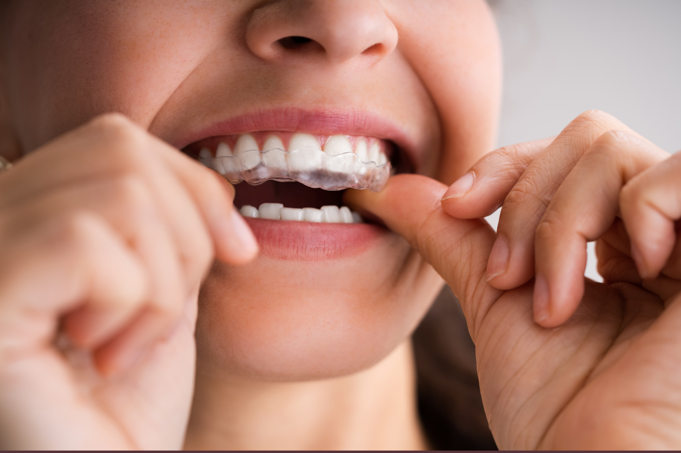 bioclear teeth