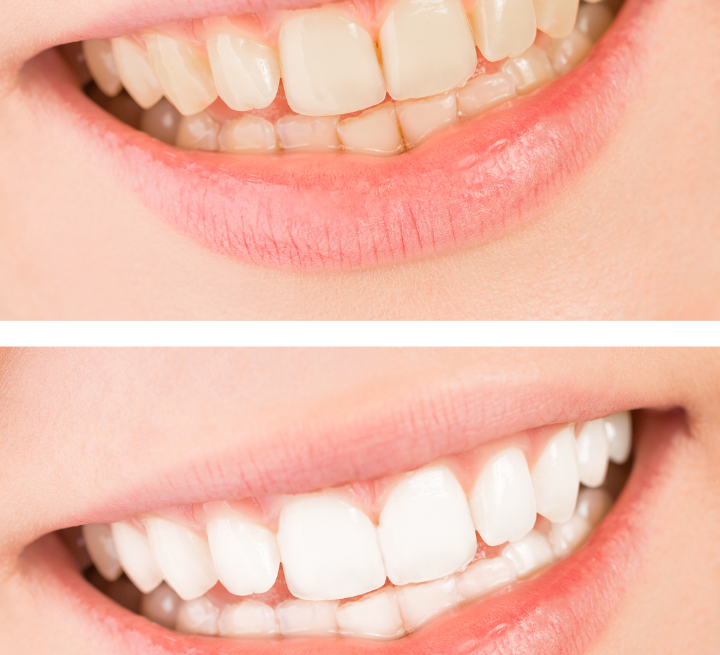Best smile makeover.