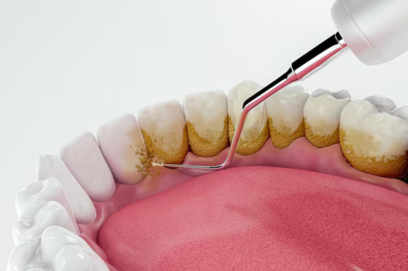 resin infiltration