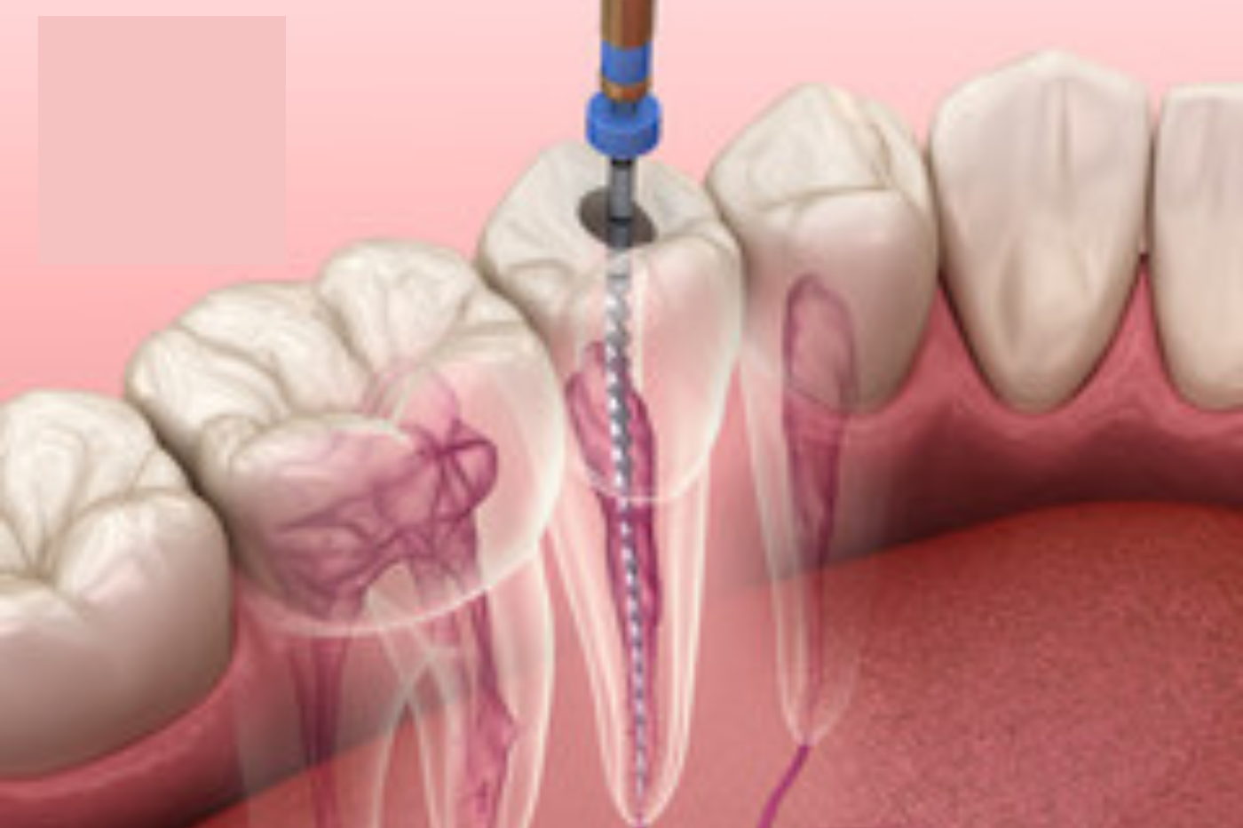 Painless Root Canal Treatment