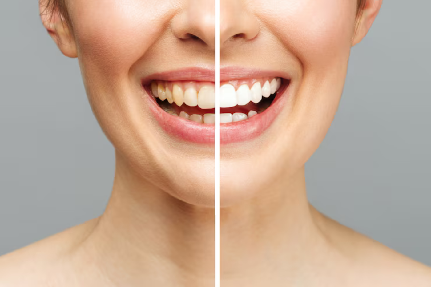Teeth Whitening