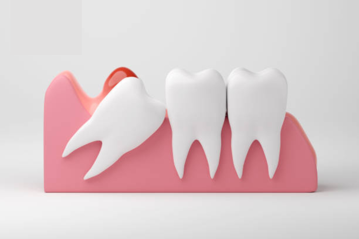 Wisdom Tooth Extraction