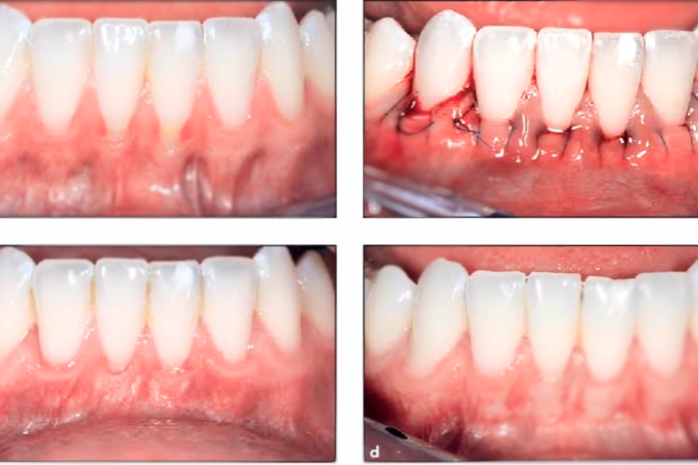 Gum Surgery