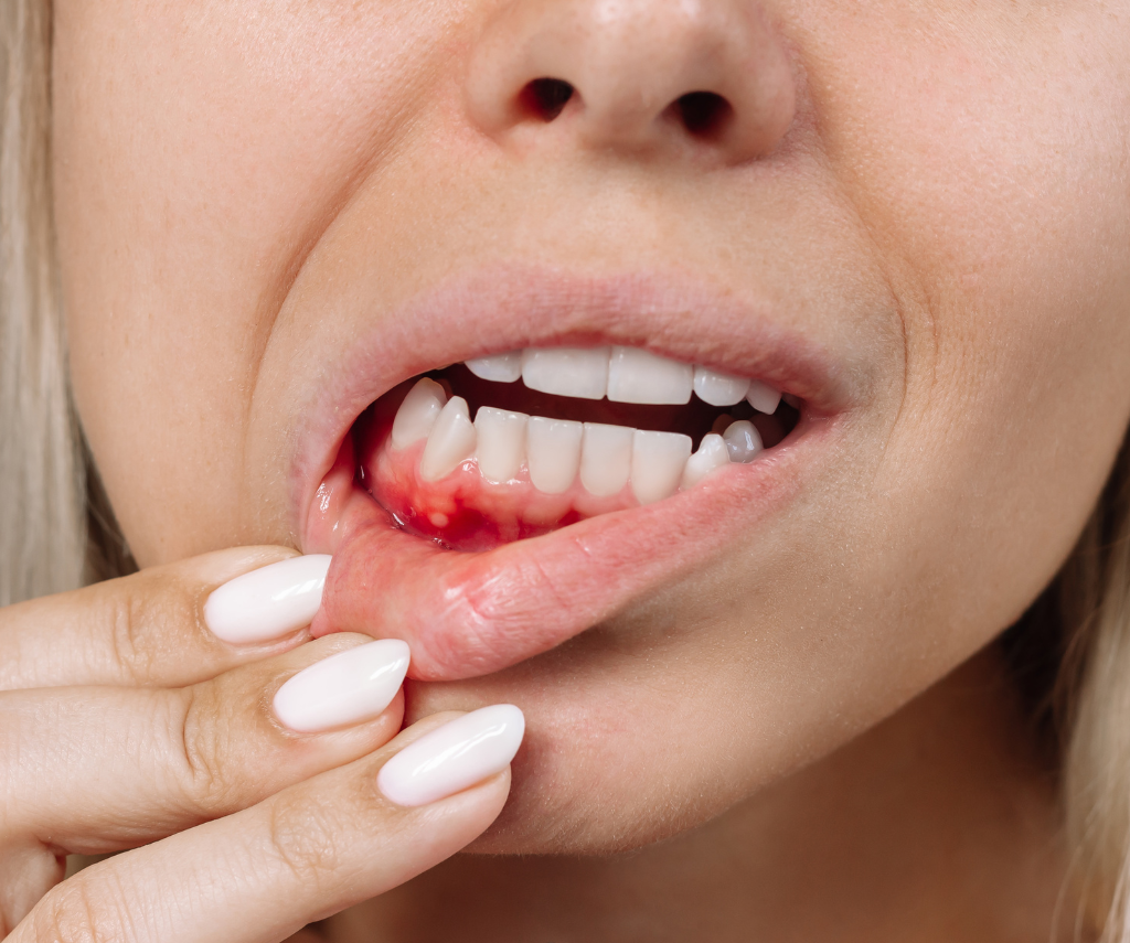 Gum Surgery