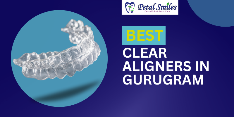 Best clear aligners in gurugram