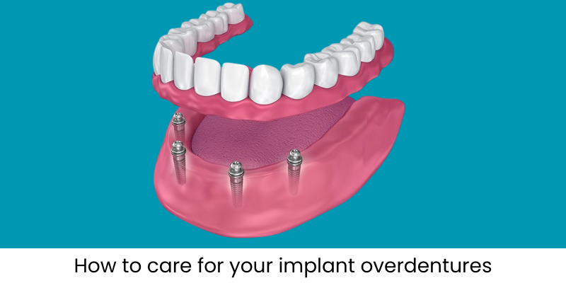 How to care for your implant overdentures (1)