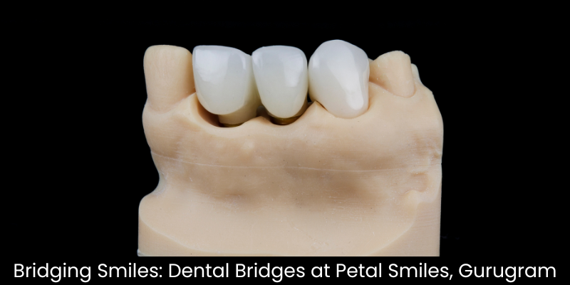 Dental Bridges treatment at Petal Smiles, Gurugram restoring missing teeth naturally