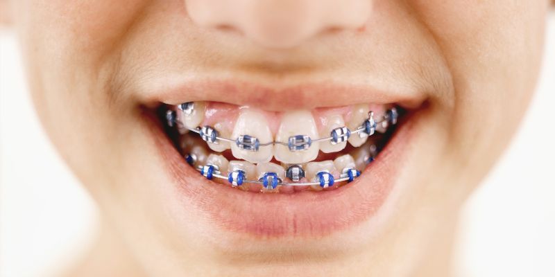 Children’s braces treatment in Blossom 1 & 2 at Petal Smiles Dental Clinic