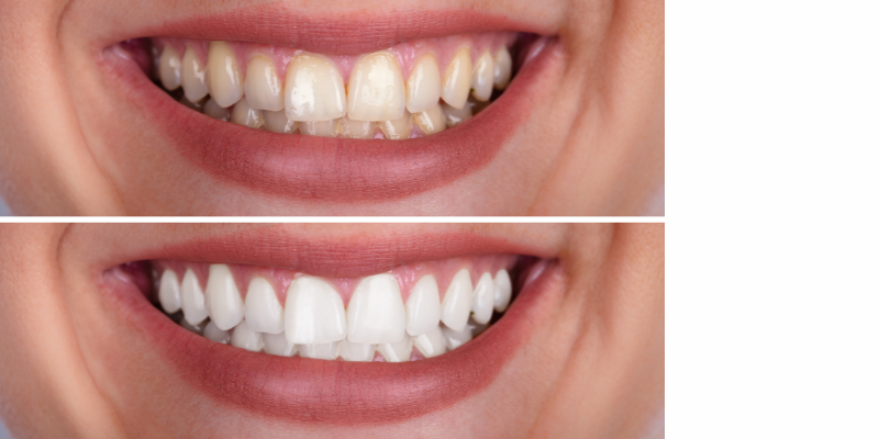 Full Mouth Smile Rebuild in Gurugram by Dr. Adish Chaudhary at Petal Smiles Dental Clinic