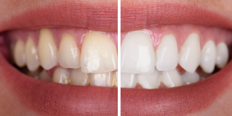 Full Mouth Smile Rebuild in Gurugram by Dr. Adish Chaudhary at Petal Smiles Dental Clinic