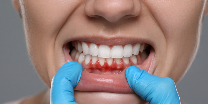 Gum contouring treatment at Petal Smiles Dental Clinic near Uppal Southend for a balanced, confident smile