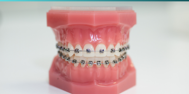 Lingual braces treatment by Dr. Adish Chaudhary at Petal Smiles Dental Clinic, Emaar Marbella, Gurugram