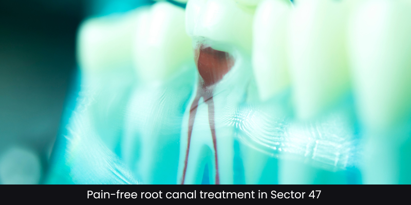 Pain-free root canal treatment by Dr. Adish Chaudhary at Petal Smiles, Sector 47 Gurugram