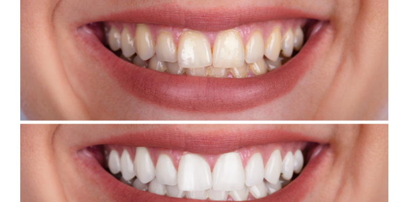 Professional teeth whitening near M3M Golfestate at Petal Smiles Dental Clinic