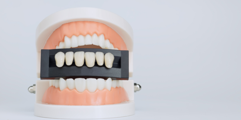 Dental veneers near Rosewood City at Petal Smiles Dental Clinic