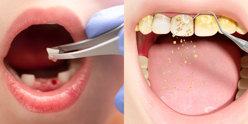 Painless tooth filling and dental cleaning near Sushant Lok 2 at Petal Smiles Dental Clinic, Gurugram by expert dentist Dr. Adish Chaudhary.