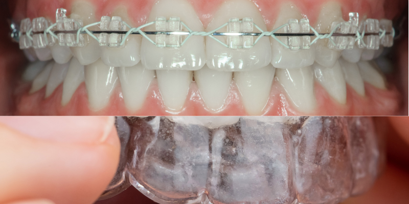 Clear aligners vs ceramic braces in Gurugram – Teeth straightening options comparison