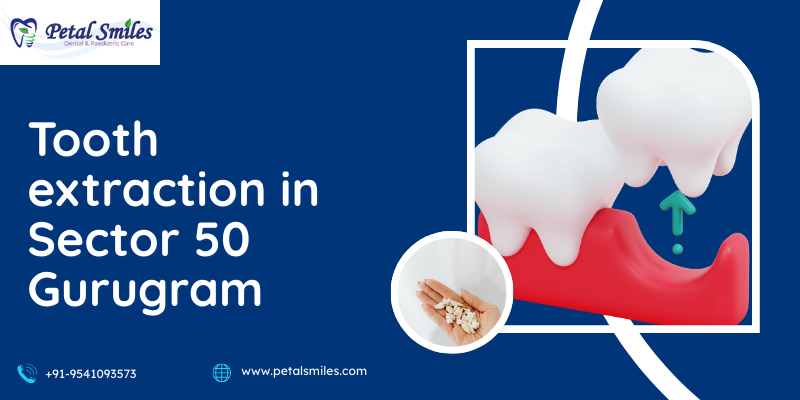 Tooth extraction in Sector 50 Gurugram performed by dentist at Petal Smiles Dental Clinic