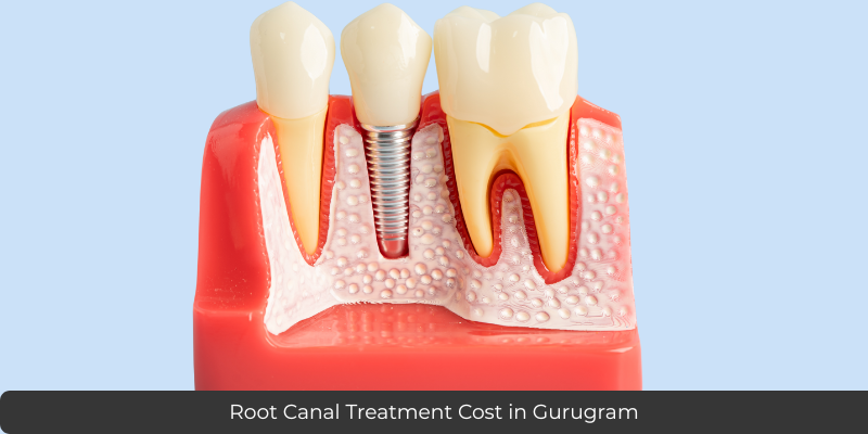 Root Canal Treatment cost in Gurgaon at Petal Smiles Dental Care by Dr. Adish using advanced pain-free RCT technology