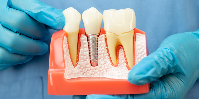 Pain-free root canal treatment near Sohna Road Gurugram at Petal Smiles dental clinic