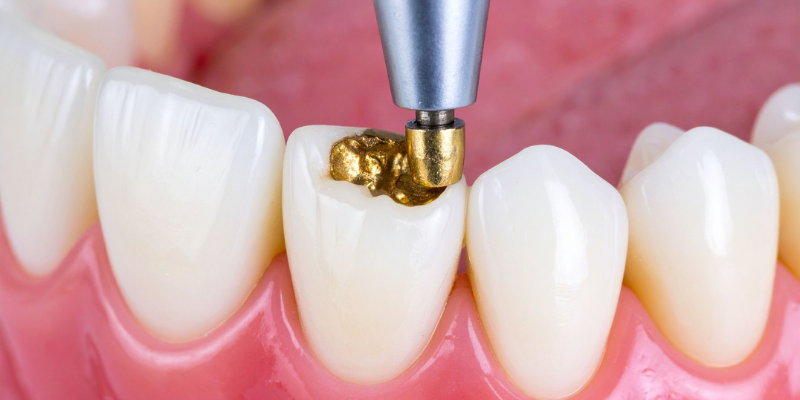 Tooth filling in Sector 56 Gurugram at Petal Smiles using tooth-colored composite filling