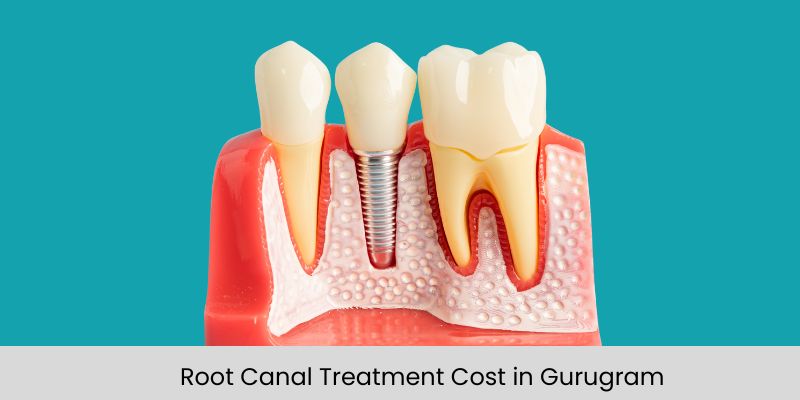 Root canal treatment cost in Gurugram illustrated with tooth anatomy and dental procedure