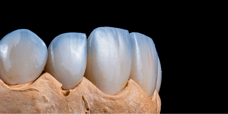 Natural looking veneer dentist near Galleria Gurgaon before and after smile makeover at Petal Smiles