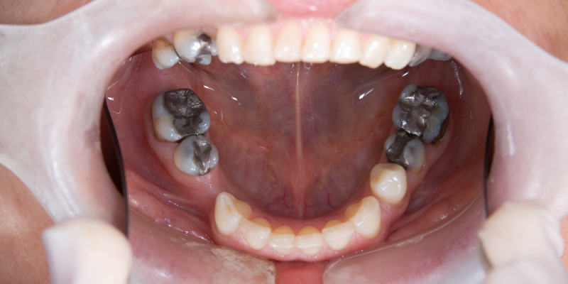 Full mouth rehabilitation treatment in Gurgaon by Dr Adish Chaudhary