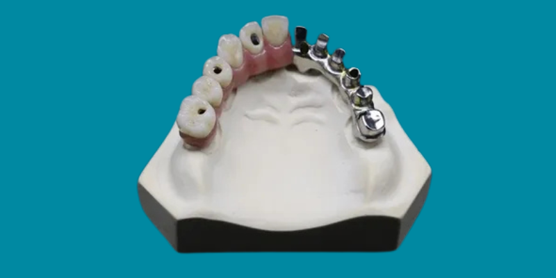 Best Doctor For Paulo Malo Bridge Treatment in Gurgaon before and after results at Petal Smiles