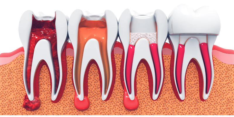 Best clinic for root canal treatment in Gurugram at Petal Smiles