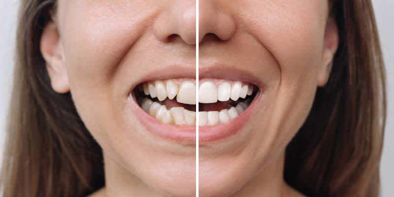 Smile makeover in Gurgaon by Dr. Adish Chaudhary at Petal Smiles showing before and after results