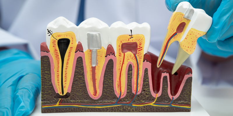 Best Clinic For Root Canal Treatment clinic In Gurugram at Petal Smiles
